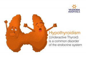 Hypothyroidism