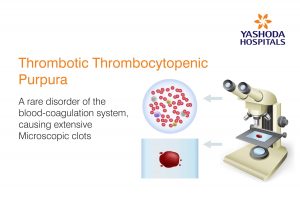 thrombotic thrombocytopenic purpura