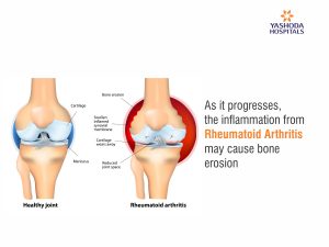 Rheumatoid Arthritis-Symptoms, Diagnosis and Treatment