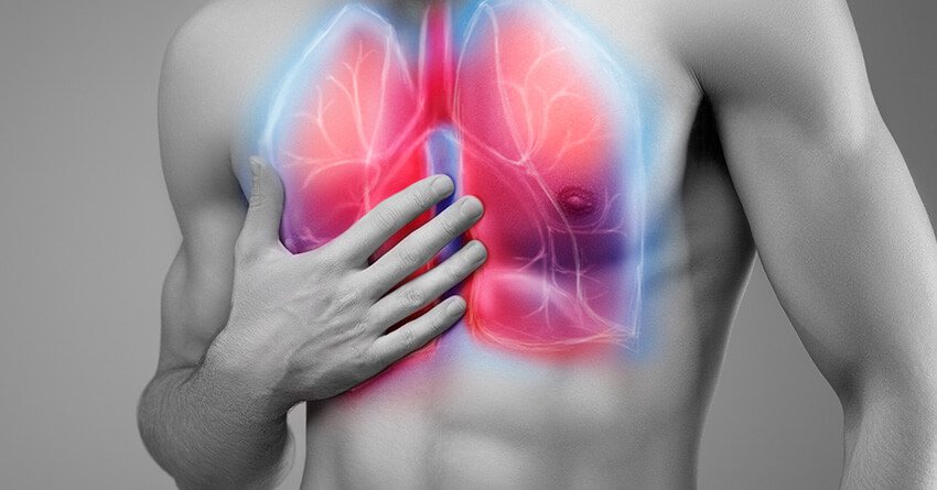 Acute Respiratory Distress Syndrome