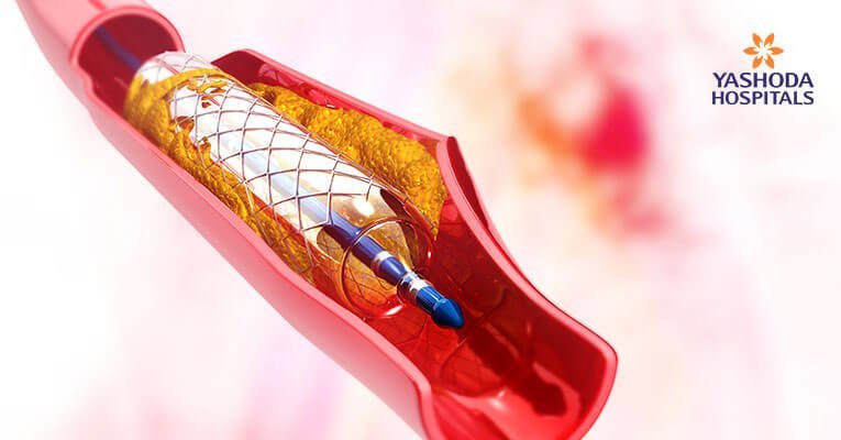 Angioplasty cases