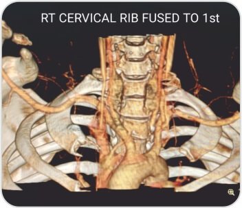 Case of Arterial Thoracic Outlet Syndrome