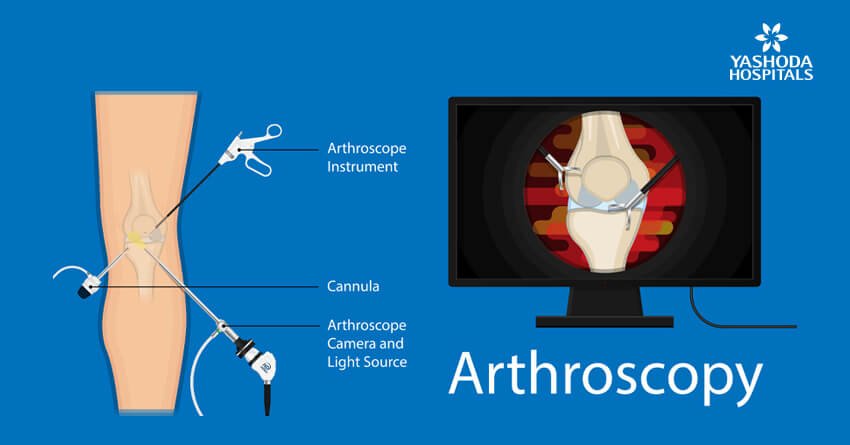 Arthroscopic ACL reconstruction surgery