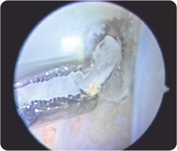 Arthroscopic Revision ACL (Anterior Cruciate Ligament) Reconstruction