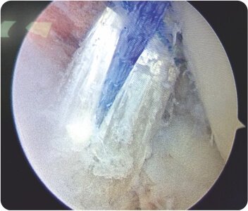 Arthroscopic Revision ACL (Anterior Cruciate Ligament) Reconstruction