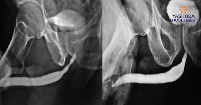 BEES-HAUS-procedure-Urethrogram-feature