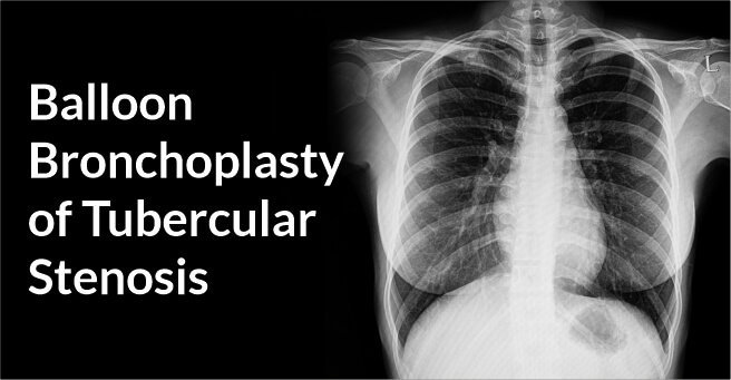 Balloon Bronchoplasty of Tubercular Stenosis