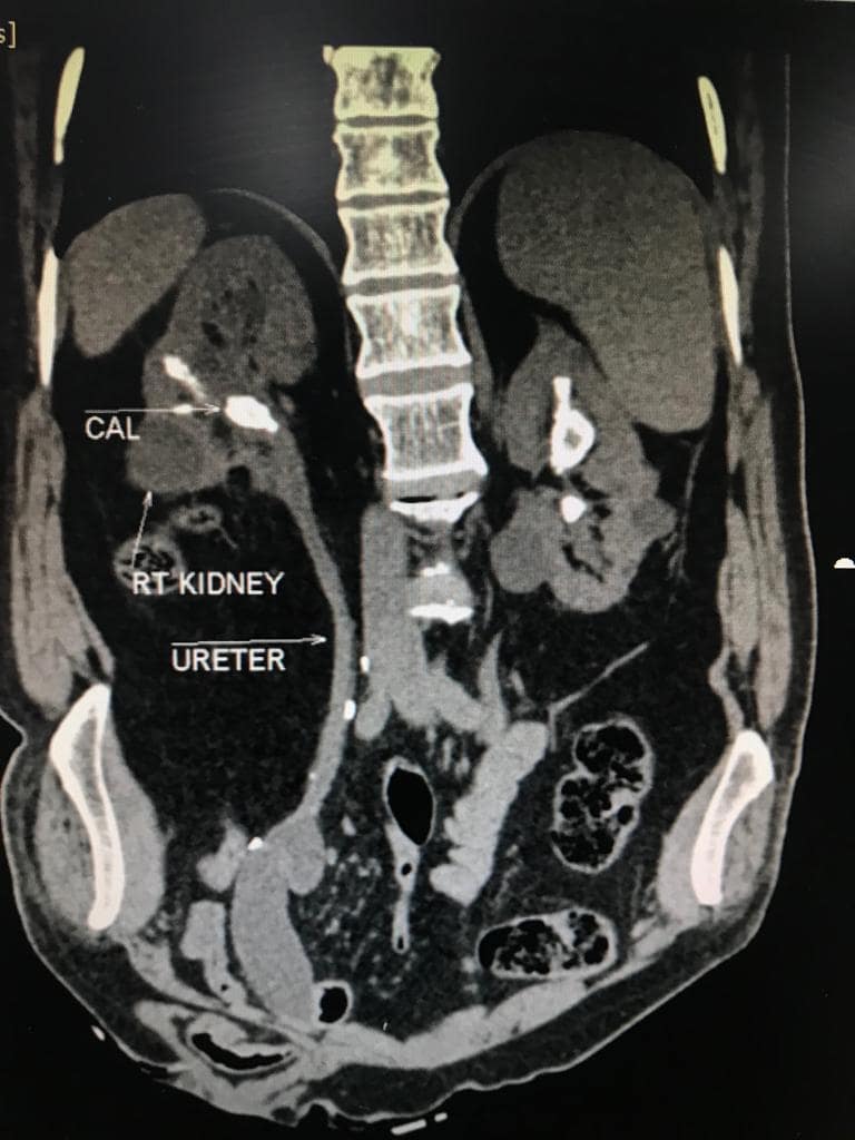 Bilateral PCNL