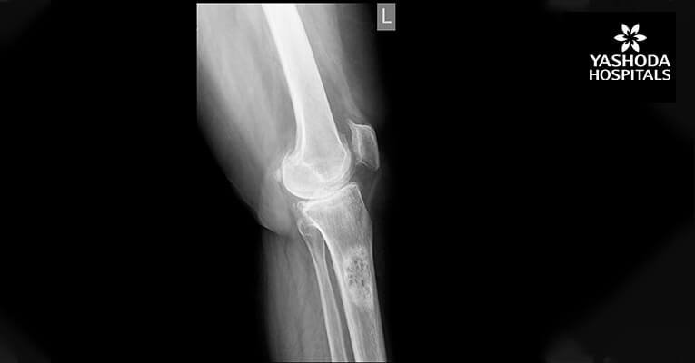 benign tumor containing both bone and cartilage