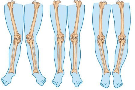 Symptoms and Complications of Bowed Legs