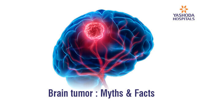 Brain Tumor Myths and Facts