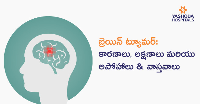 బ్రెయిన్‌ ట్యూమర్‌ (Brain Tumor): కారణాలు, లక్షణాలు & వాస్తవాలు