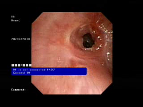 Tracheal Stenosis Before Dilatation