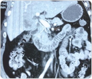 Extended Cholecystectomy with CBD Excision for Squamous Cell Carcinoma of Gall Bladder