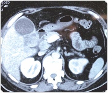 Extended Cholecystectomy with CBD Excision for Squamous Cell Carcinoma of Gall Bladder