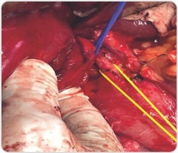 Extended Cholecystectomy with CBD Excision for Squamous Cell Carcinoma of Gall Bladder