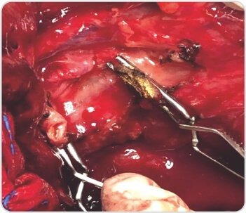 Extended Cholecystectomy with CBD Excision for Squamous Cell Carcinoma of Gall Bladder