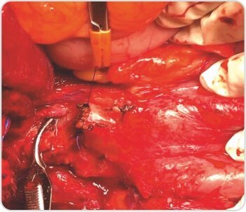 Extended Cholecystectomy with CBD Excision for Squamous Cell Carcinoma of Gall Bladder