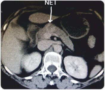 Central Pancreatectomy