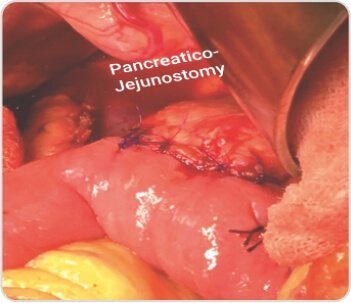 Central Pancreatectomy