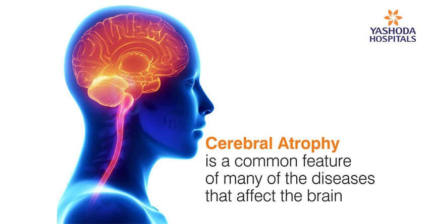 Cerebral atrophy is a common feature of many of the diseases that affect the brain