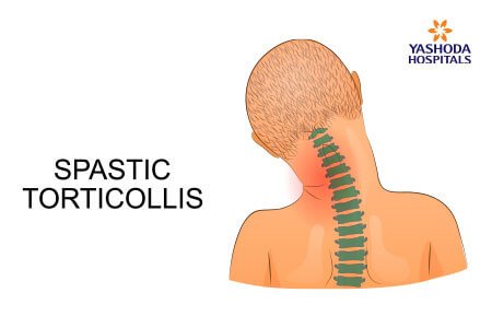 Congenital Muscular Torticollis causes