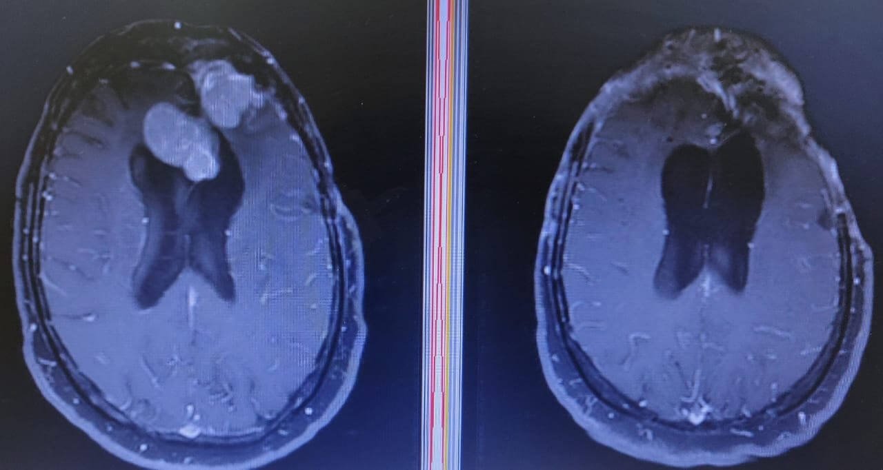 Craniotomy and complete resection of recurrent parafalcine meningioma