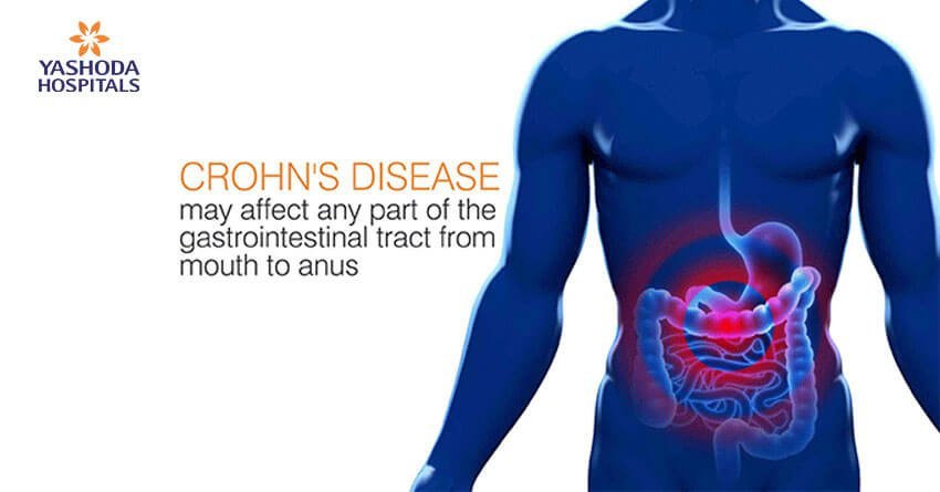 GERD (gastroesophageal reflux disease) may lead to Barrett's esophagus