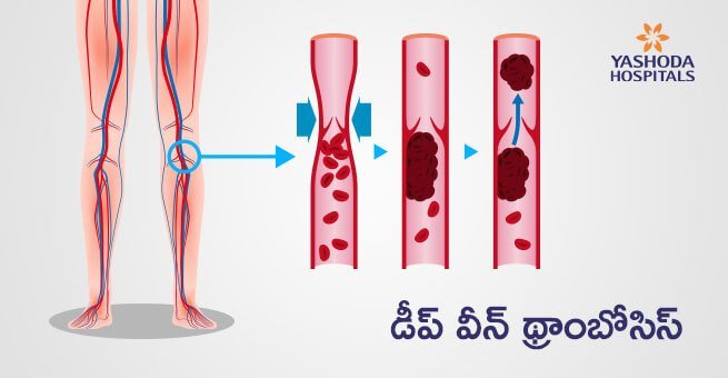 Deep Vein Thrombosis in Telugu