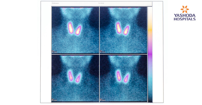 Detect Thyroid Cancer