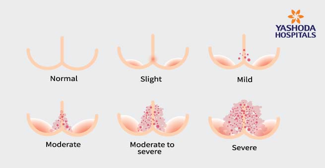 Diaper Rash Types