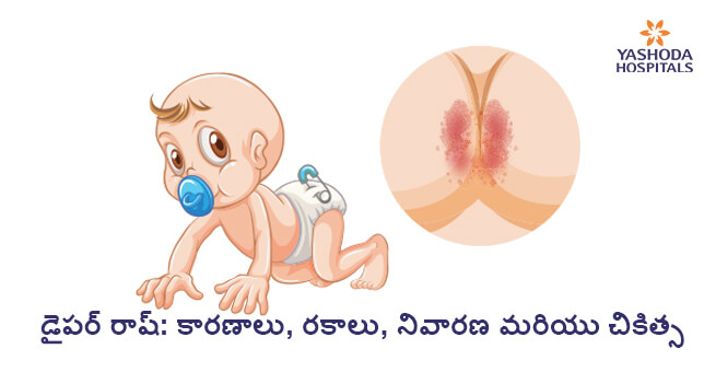 Diaper rash causes treatment