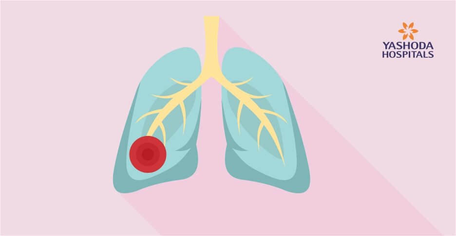 Effected Lung