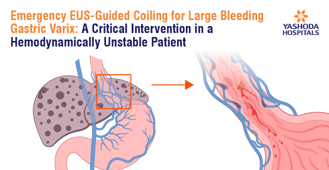 EUS-Guided Coiling for Hemorrhagic Gastric Varices