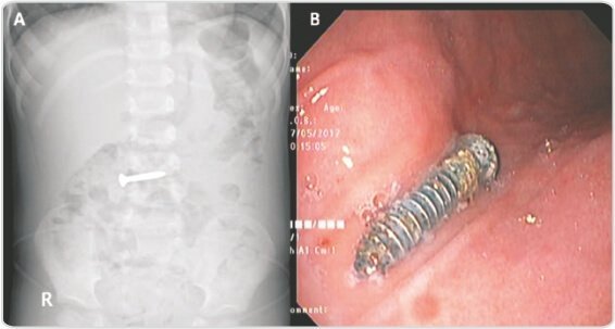 Endoscopic Removal of Foreign Body