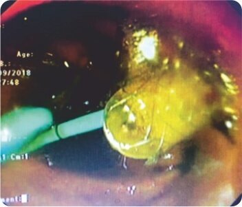 Endoscopic Ultrasound Guided Hepatico - Gastrostomy