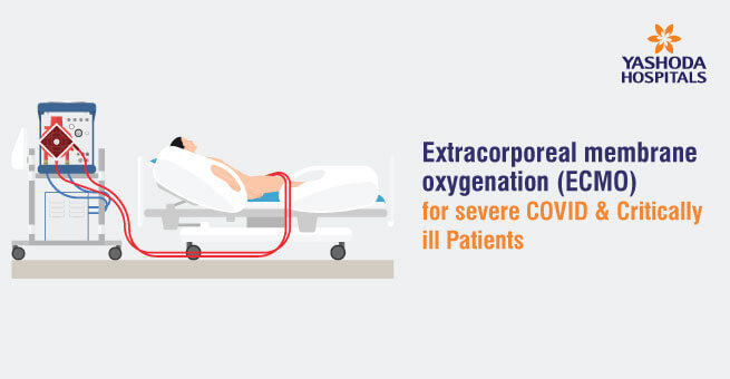 Extracorporeal membrane oxygenation