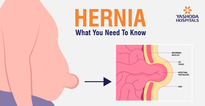 Hernia What You Need To Know_Main