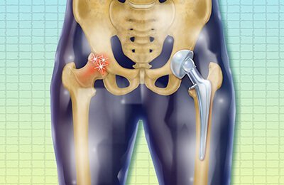 Hip Replacement Surgery