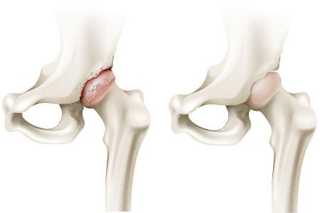 Symptoms, Risk Factors and Complications of Hip Arthritis