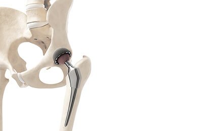 Hip arthroscopic surgery