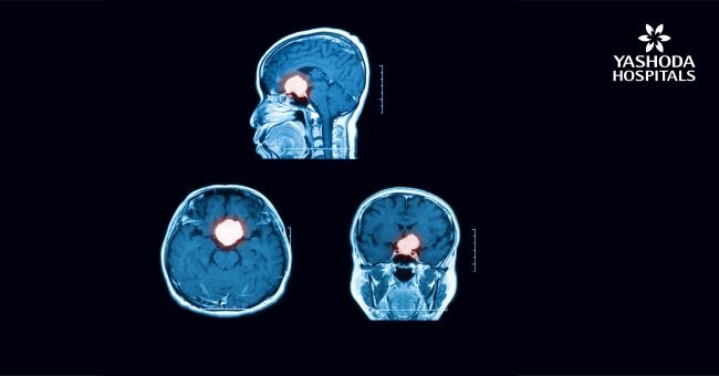 How are pituitary tumours diagnosed