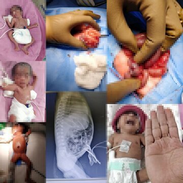 Ileostomy in premature baby