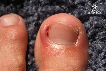 Ingrown Toenail: Symptoms and Complications