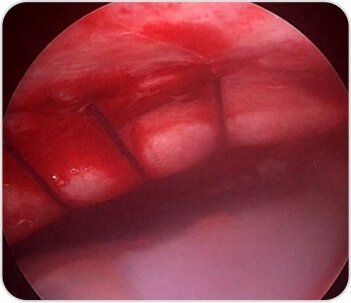 Intercostal hernia repaired with interrupted prolene sutures