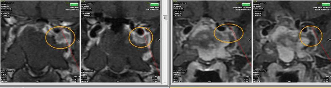 Intra-operative