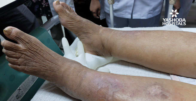 Lymphatic Filariasis