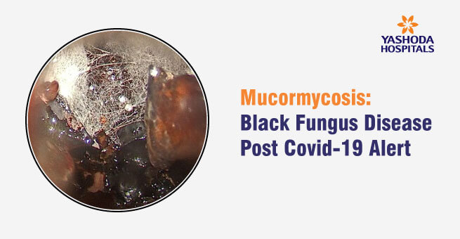 Mucormycosis