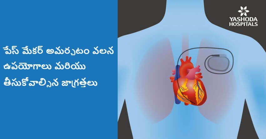 Pacemaker for heart arrhythmia treatment