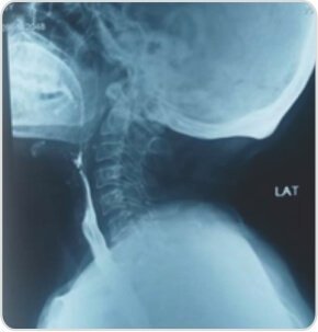 Papillary Carcinoma of Thyroid